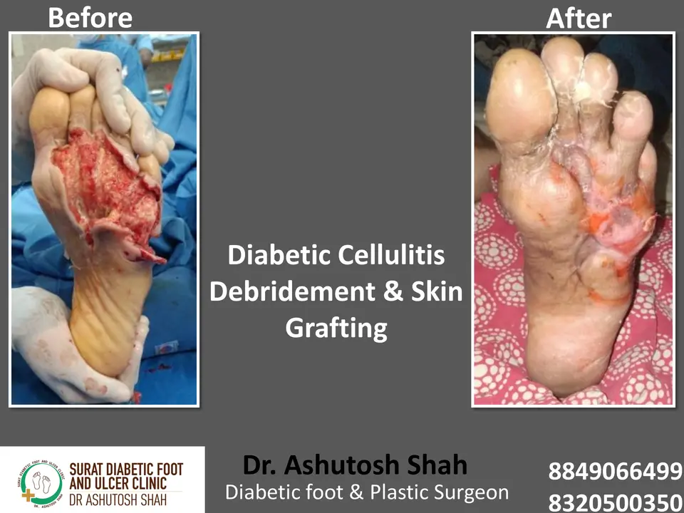 Diabetic Foot  PPT sunita.pptx-28.webp